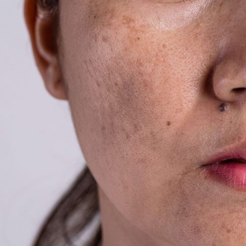woman-with-problematic-skin-acne-scars-problem-skincare-concept (1)